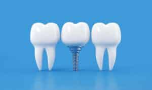 Dental Implants and Aging
